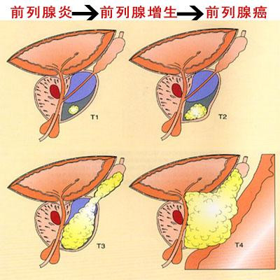 前列腺增生容易导致哪些尿路危害