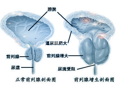 该如何防治前列腺增生